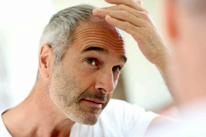 Alopezie Typen Und Wie Man Sie Behandelt